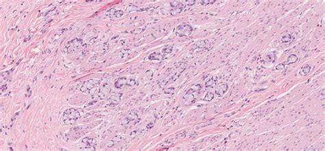 Goblet cell adenocarcinoma of the appendix | Atlas of Pathology