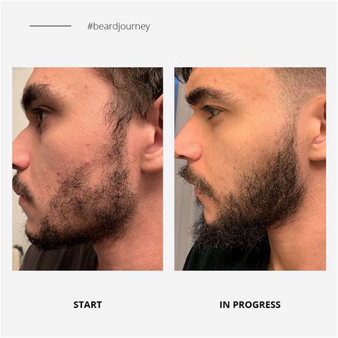 beard growth results | Beard growth kit, Beard growth, Best beard growth