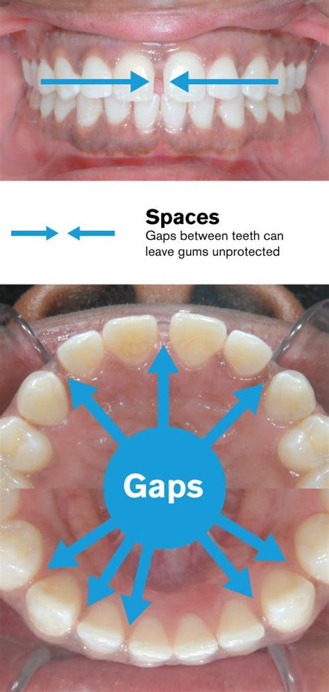 Spaces between teeth closed with braces · South Brunswick NJ