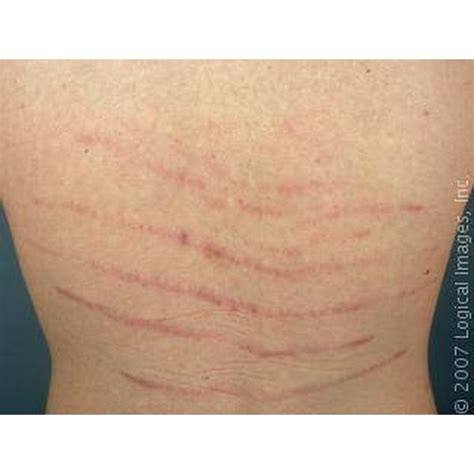 What Causes Stretch Marks On the Lower Back? | Healthfully