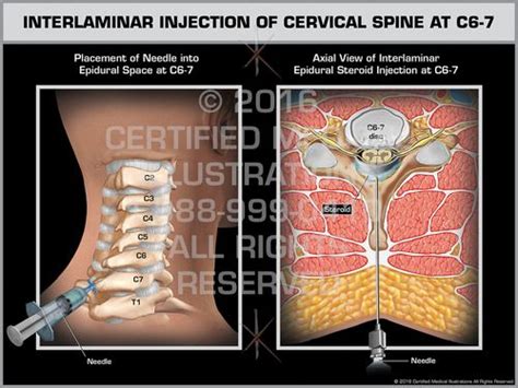 Interlaminar Injection of Cervical Spine at C6-7 - Print Quality Instant Download | Cervical ...