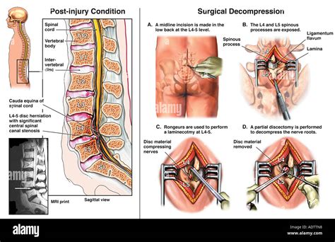 Lumbar Disc Herniation L4-5 with Surgical Laminectomy and Discectomy ...