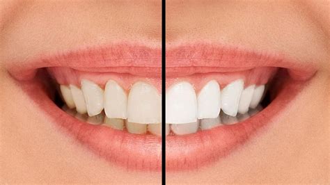 Teeth Whitening | Cosmetic Dentist in Pico Rivera | PhD Dental