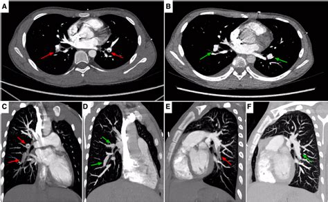 Chest CTA, axial (A,B), sagittal (C–F) images, showing locations of PE.... | Download Scientific ...