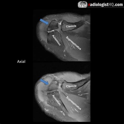 Os acromiale on MRI : r/Radiology