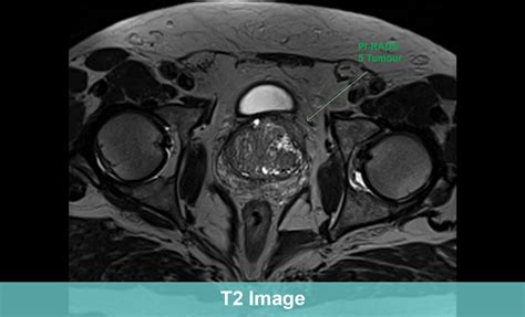 Prostate Cancer Mri Images