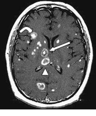 Figure 1 from Cerebral toxoplasmosis: case review and description of a new imaging sign ...