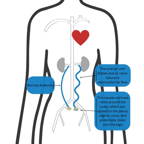 Gonadal Vein Reflux / Pelvic Venous Congestion Syndrome (PVCS) - TRA ...