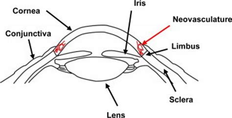 Diagram of corneal structure and corneal neovascularization. For a ...