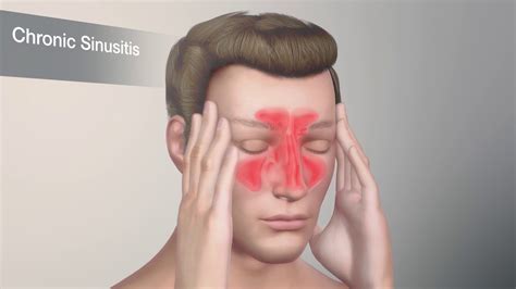 What Allergies Cause Sinus Problems? - Allergy, Asthma & Sinus Center, P.C.