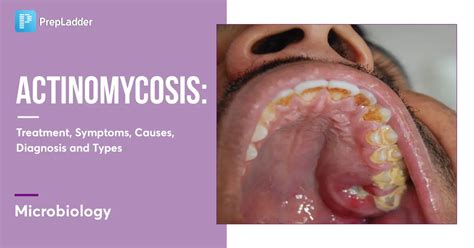 Actinomycosis Treatment, Symptoms, Causes, Diagnosis & Types