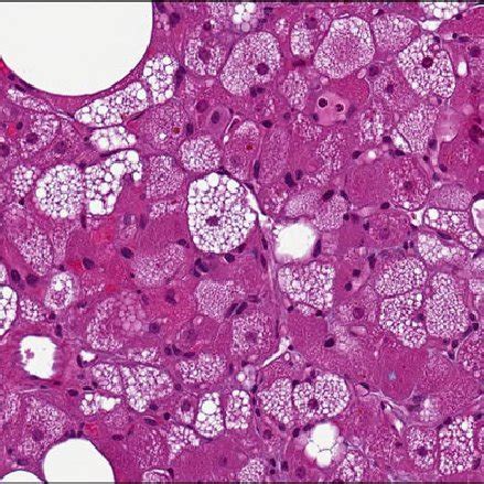 Mammary hibernoma, typical variant. Representative micrographs of the ...