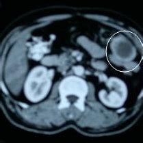 CT scan image showing the omental mass adjacent to bowel loop (circle ...