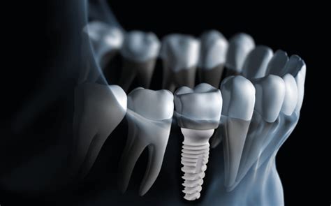 Zirconia Dental Implants Las Vegas, NV - Four Seasons Dental Spa