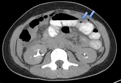 CT abdomen/pelvis with intravenous and oral contrast showing new free ...