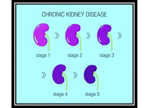 5 Stages of Kidney Disease | Dr. Kavitha Gone Explains