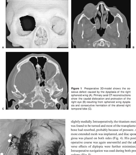 Reconstruction of Sphenoid Wing Dysplasia with Pulsating Exophthalmos ...