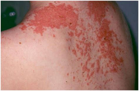 Maculopapular Rash - Causes, Symptoms, Treatment, Pictures, Diagnosis ...