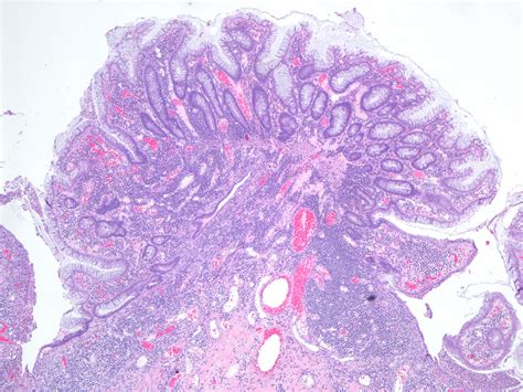 Fulminant ulcerative colitis: pseudopolyp | Acute severe (fu… | Flickr