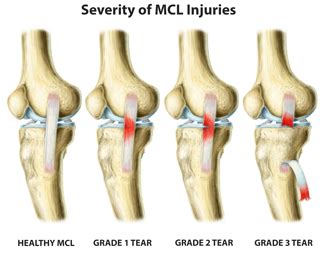 MCL Sprain Options