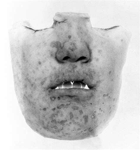 Photograph: facial scars of smallpox; | Wellcome Collection