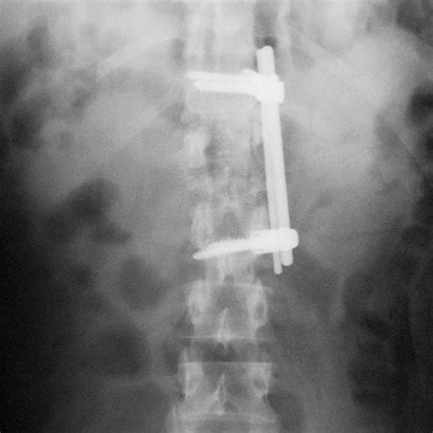 (PDF) Total L1 Vertebrectomy With T12-to-L2 Fusion in a Case of Burst Fracture