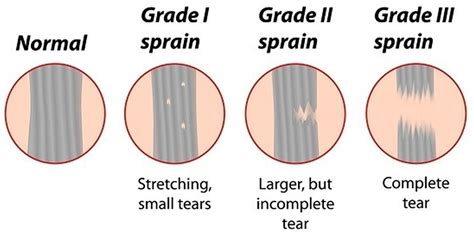 Hamstring Injury - Causes, Symptoms, Recovery Time & Treatment