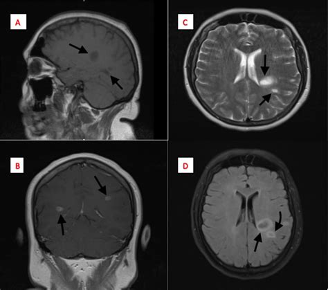 Cureus | Tumefactive Multiple Sclerosis, A Rare Variant Presenting as ...