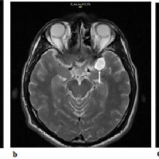 Coronal FLAIR MRI: In left Sylvian fissure, as result of multiple ...