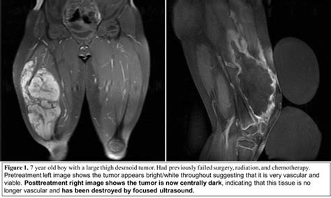 Desmoid Tumors | UCSF Radiology