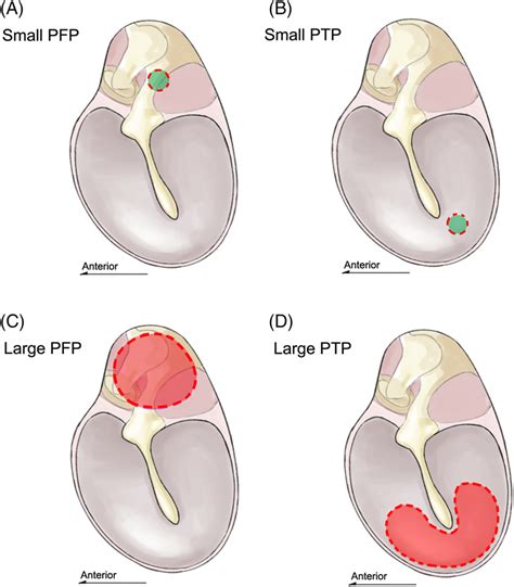 Schematic showing perforation sizes and locations. (A) A TM with a... | Download Scientific Diagram