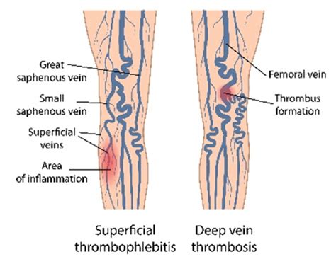 Superficial Thrombophlebitis - New York Vein Treatment Center