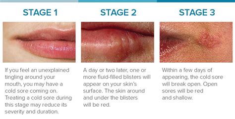 Cold Sore Stages: Identification and Treatment