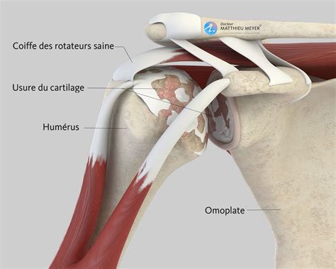 prothèse totale d’épaule - Docteur Matthieu Meyer