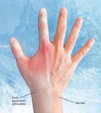 The Symptoms and Stages of Frostbite - ShoenSafety LLC