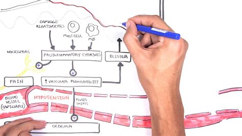 Burns - Pathophysiology - Medical Follower