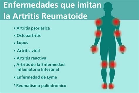 8 enfermedades que podrían parecerse a la artritis reumatoide y ...