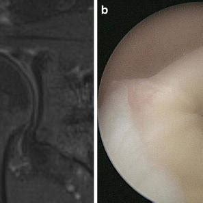 MRI (a) and arthroscopy (b) show the SLAP lesion (true positive ...