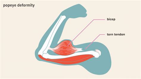 A Bulge In The Arm Like Popeye, Diagnosis? - MEDizzy Journal