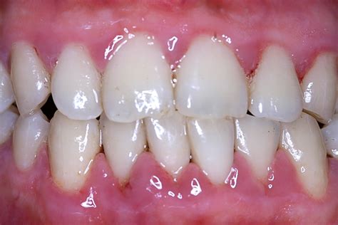 Gingivitis Before And After Treatment