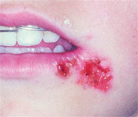 Dental Care: Oral Disease: Herpes Labialis