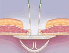 Hernia Types - Umbilical - California Hernia Specialists