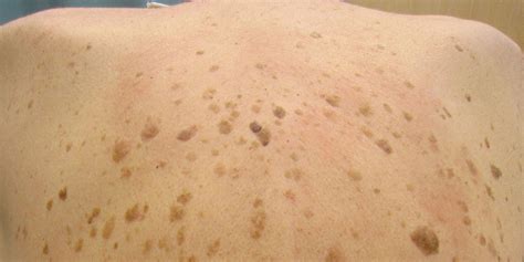 Portland Seborrheic Keratosis Treatment | Norris Dermatology