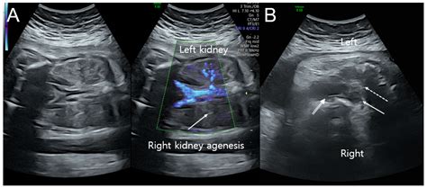 Medicina | Free Full-Text | Prenatal Diagnosis of Fetal Obstructed ...