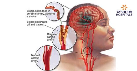 Effective Procedure for Acute Ischemic Stroke