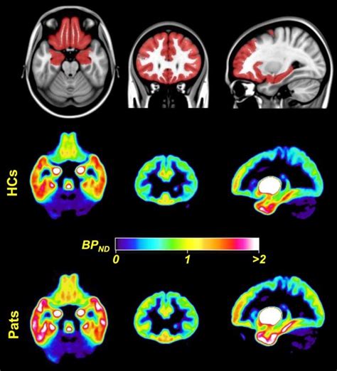 Example of dopaminergic imaging using 11 C-FLB457. Upper panel shows ...