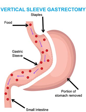 Gastric Sleeve