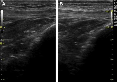 (A, B) Adjustment of focal zone. The focal zone markers are usually... | Download Scientific Diagram