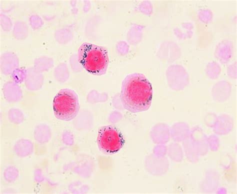 Refractory Anemia With Ring Sideroblasts - StatPearls - NCBI Bookshelf