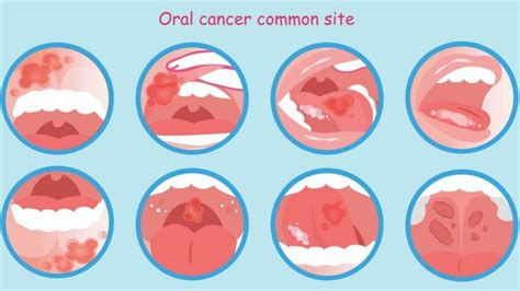 Common Causes of Sore Tongue – 1MD Nutrition